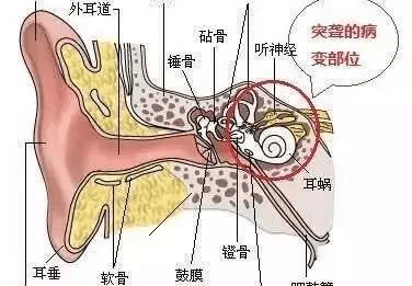 贵阳铭仁耳鼻喉医院:你知道吗?突发性耳聋发病后72小时是治疗黄金期