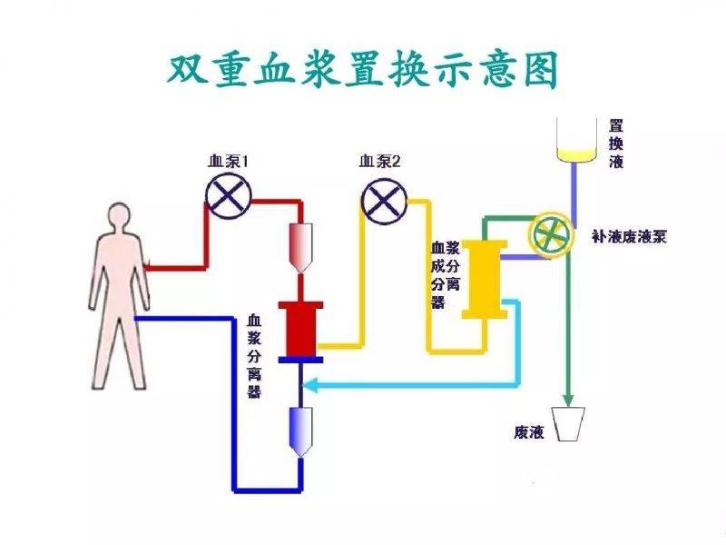 全身性dfpp血液淨化這類人建議做