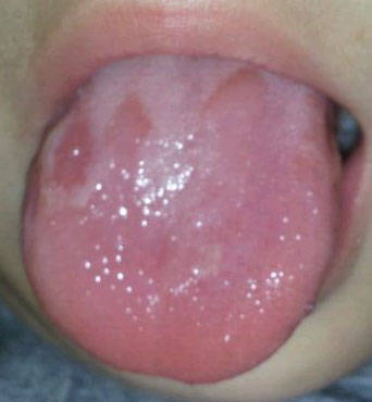 原创儿童的舌头容易出现的三种问题,哪一种需要手术治疗?