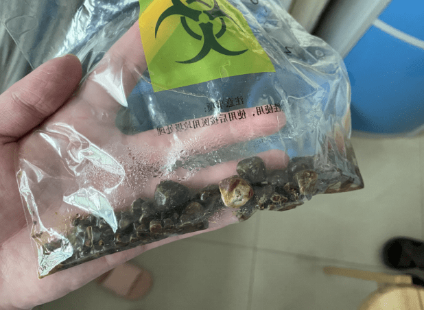 胆囊结石都应保胆取石吗?专家:尊重个人意愿,科学保胆