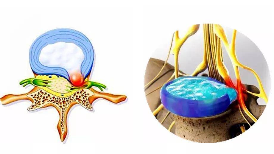 科普|脊柱科普丨腿痛？可能是腰出现了问题！