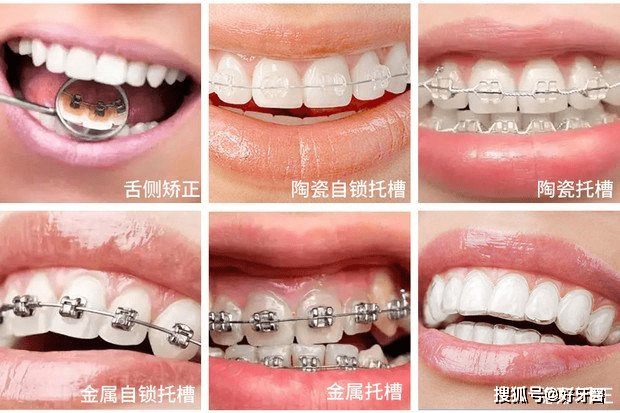 通过 透明牙套给牙齿加力,让牙齿移动来达到矫正效果的