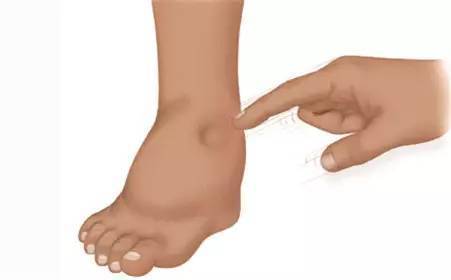 锻炼|得了肝硬化,适当运动或能收获3大好处