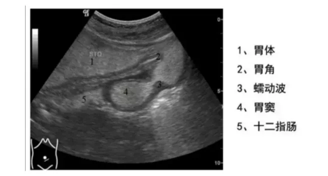 造影剂|胃肠也能做B超？专家：有其特有优势，适合七大类情况