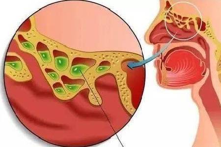 鼻窦炎有脓水怎么办
