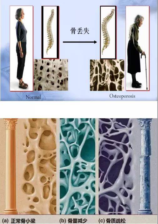 老人|老人经常腰酸背痛，需要做做这项检查