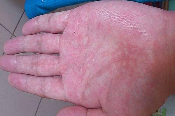 沉默|肝脏是一个沉默的器官，身体发出这些信号，是提醒你要养肝了