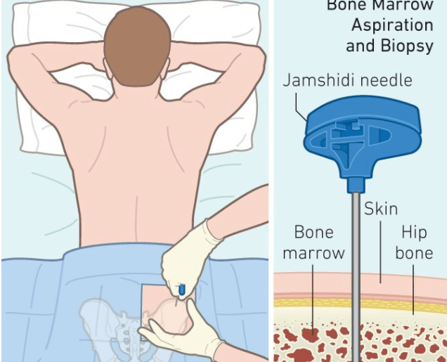 骨髓穿刺造成的伤口需要多久才可以愈合需要注意什么
