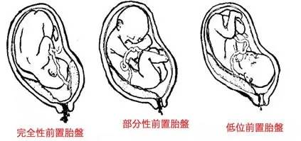 原创准妈妈有前置胎盘该怎么处理哪类人最容易患前置胎盘其他前置胎盘