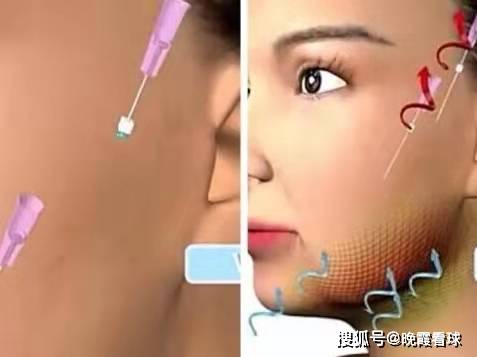 什么|什么是埋线，面部线雕后注意事项你做对了吗~