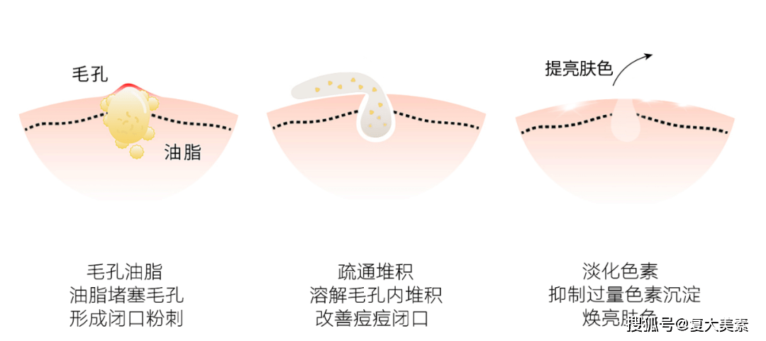 果酸|复大美素：同样都是刷酸，为什么偏偏就你烂了脸?