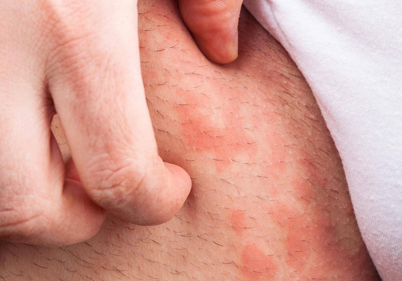 患有湿疹，需要忌口吗？