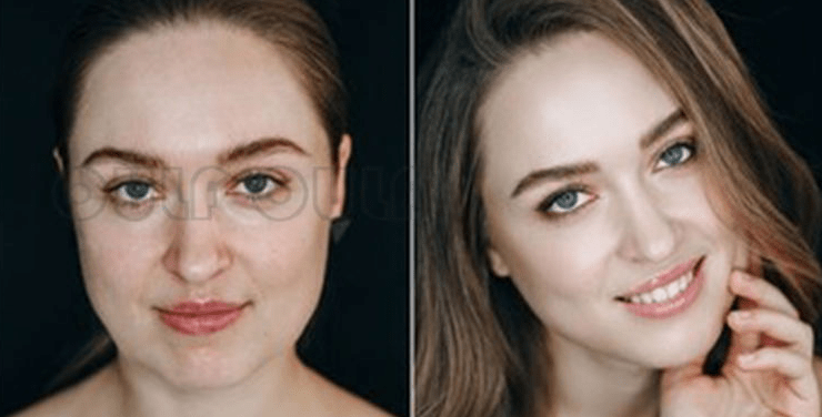 注入|面部美容填充、脂肪填充多久可以补第二次填充