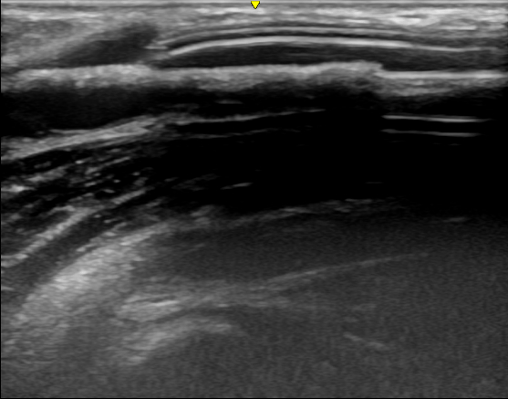 覆膜|肾脏内科实施陕西省首例超声引导下透析通路支架植入术