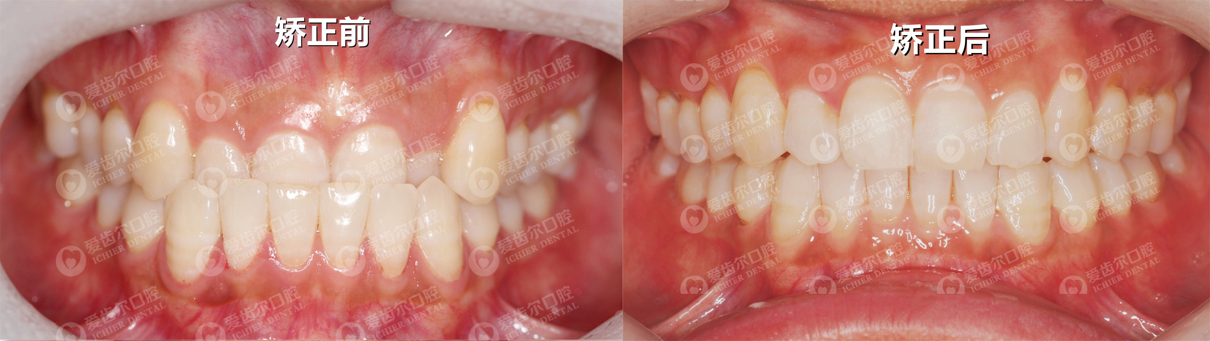 在 乳牙期和替牙期一般使用 活动矫治器来纠正 恒牙期的地包天一般