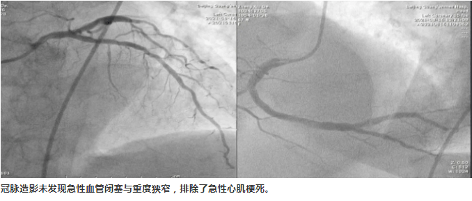 造影|内外联手、绿色通道——救治急性危重型肺栓塞患者