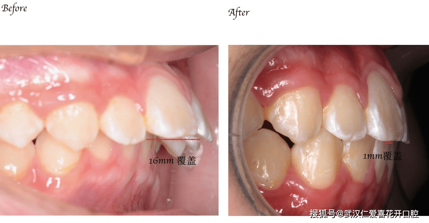 仁愛口腔嚴重突面畸形的矯形治療