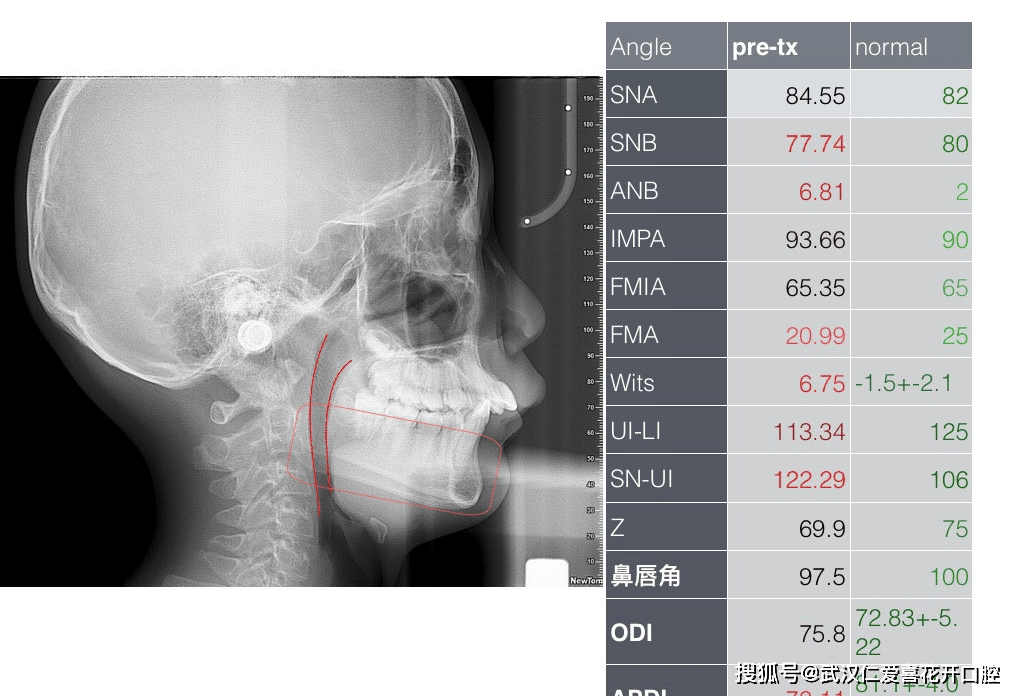 仁爱口腔#严重突面畸形的矫形治疗_下颌