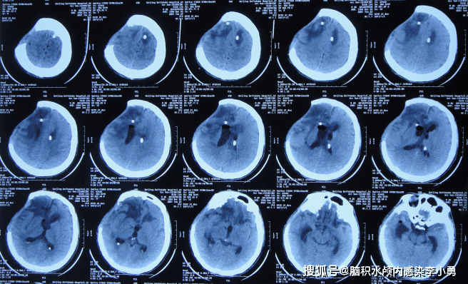 顱腦外傷開顱術後腦膨出腦積水顱內細菌感染致昏迷肢體無反應