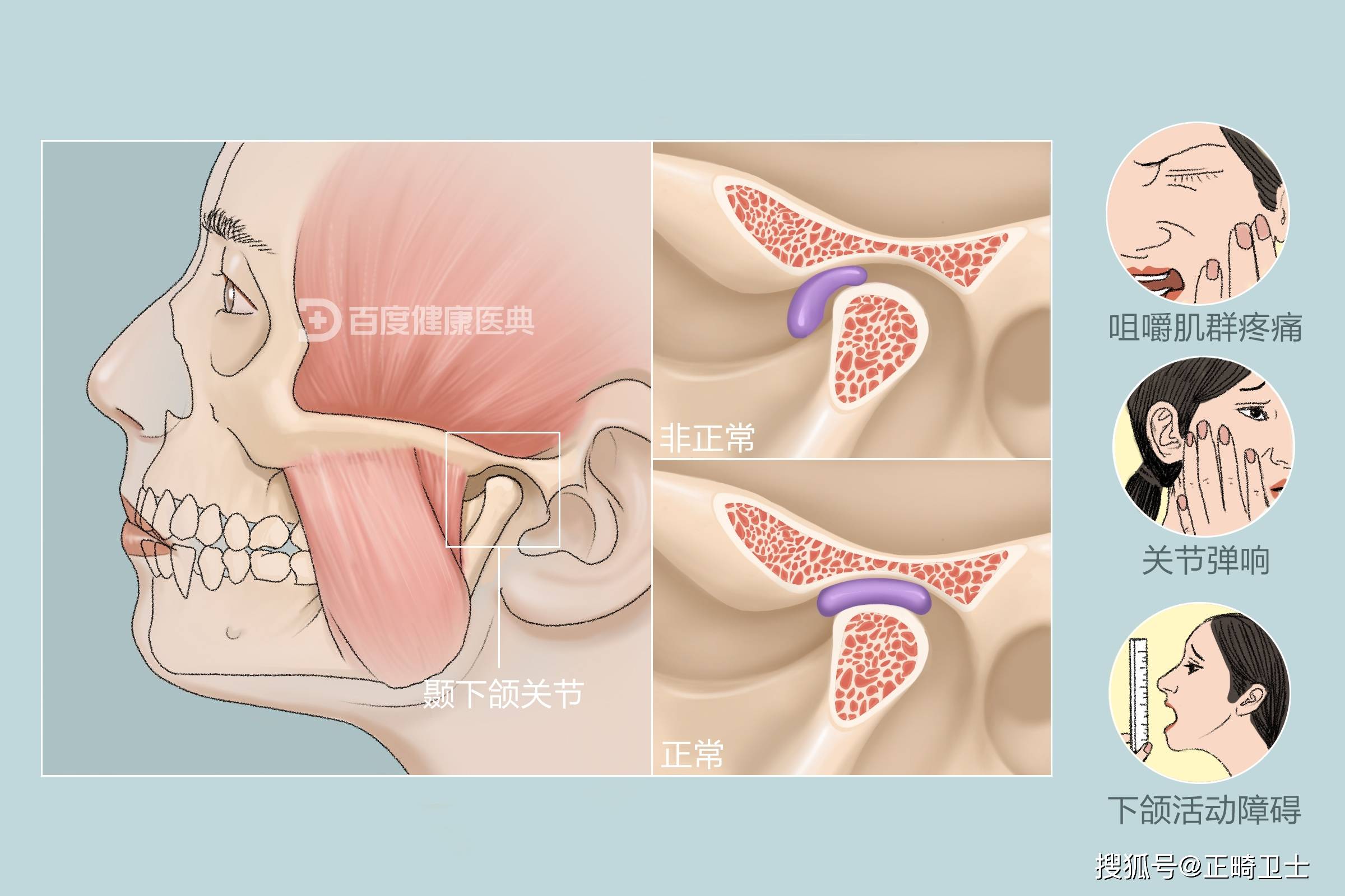 医影云|正畸治疗时医生所提到的颞颌关节紊乱症到底是什么？_搜狐网