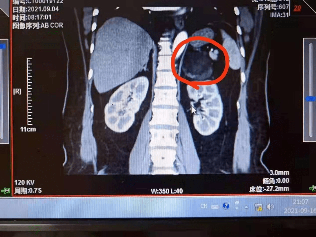 ct示左侧肾上腺肿瘤