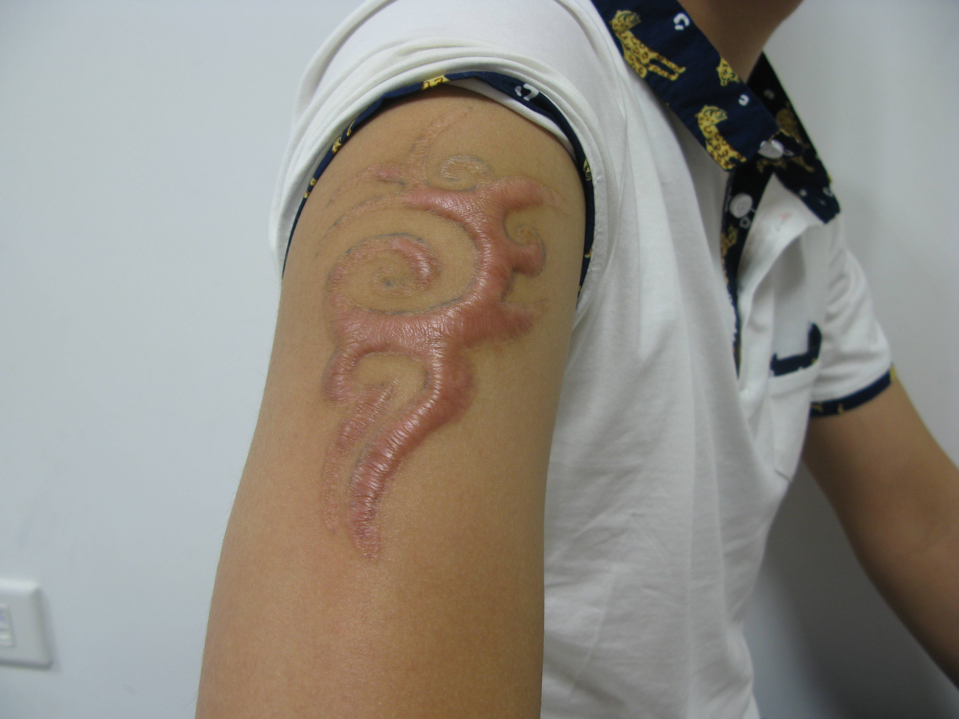 郑州市第二中医院:纹身覆盖疤痕有哪些风险?
