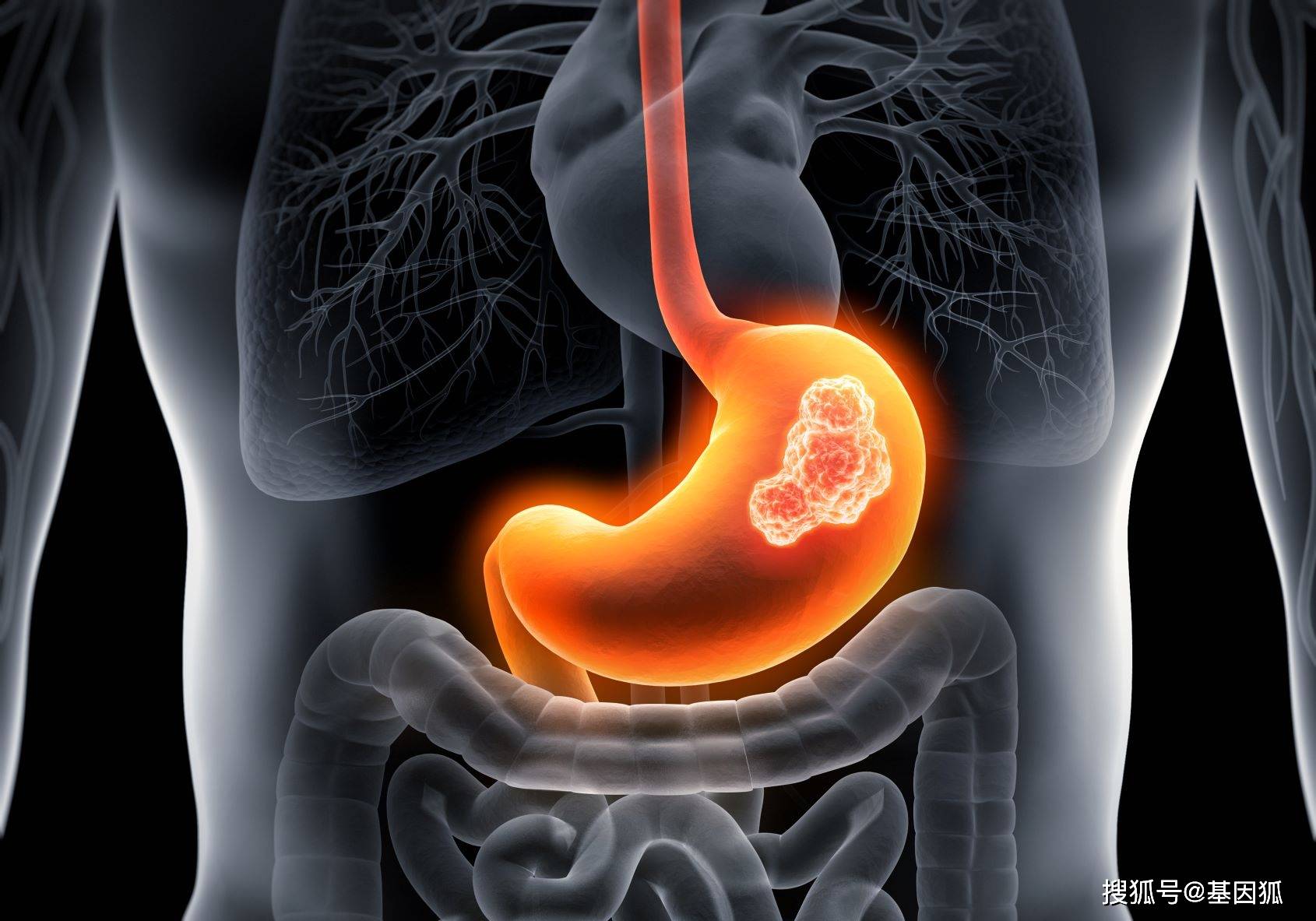胃癌征兆：这些常见症状，可能是胃癌来了！