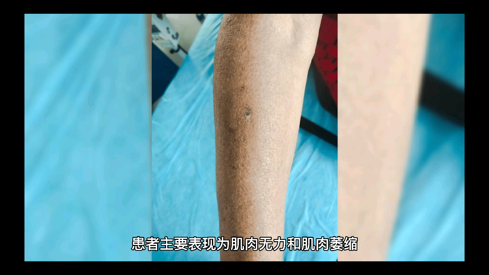 节度|运动神经元病如何饮食