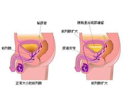 男性前列腺的位置图图片