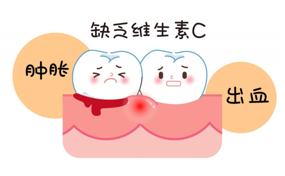 【牙龈出血】牙龈出血是什么原因_牙龈出血怎么办