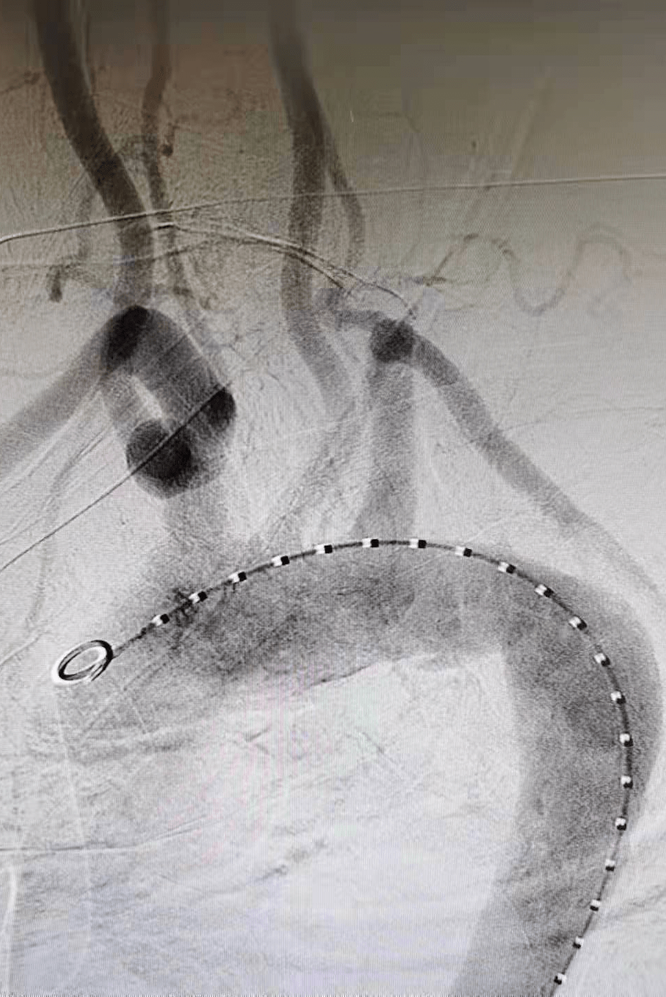 团队|罕见又危险！巨大溃疡长在主动脉上！人民医院专家团队通力合作让患者转危为安