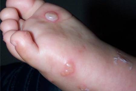 脚起大水泡怎么办引起脚起大水泡的3个原因和应对方法
