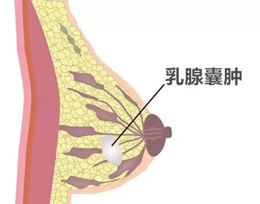 04,乳腺囊腫 乳腺囊腫是女性乳腺結構不良,炎症等原因引起的導管阻塞