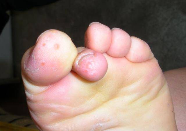 糜烂型脚气脚气有哪些类型?每个类型有哪些症状表现呢?