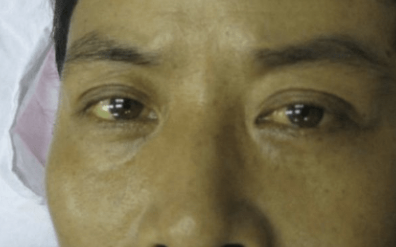 刘杰|43岁农民工皮肤过敏,3个月后确诊肝癌,医生:皮肤3种异常,早做检查