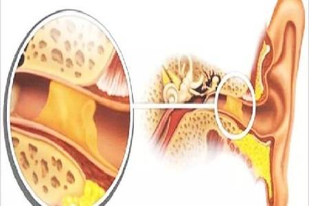 首大戴海江 为什么经常挖耳反而会导致耵聍栓塞 外耳道
