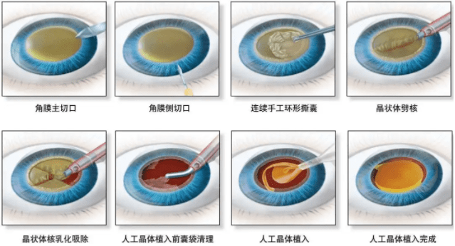 视网膜|金眼科 | 年轻人就不会得白内障？别侥幸，专家说，100%的人都可能会得