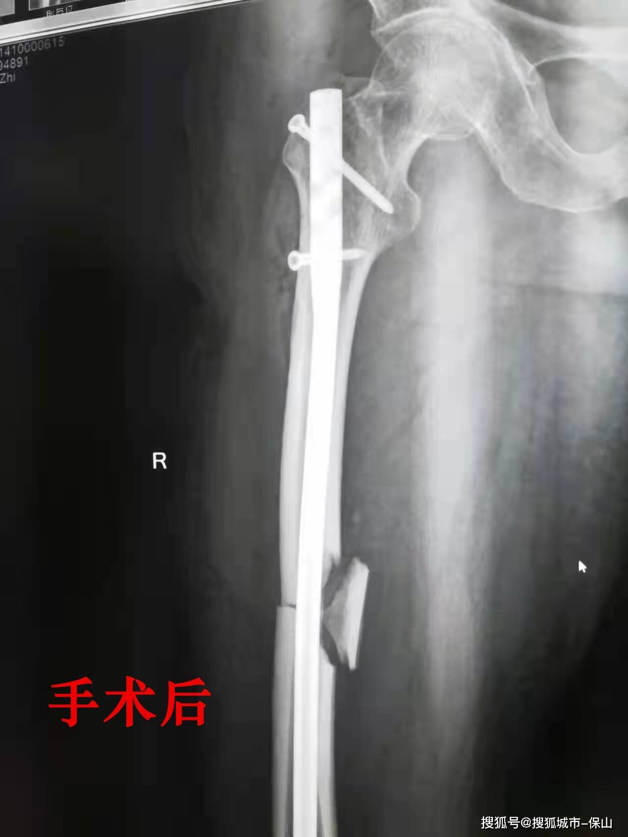 新技为龙陵72岁股骨中段骨折老人实施闭合复位髓内钉内固定手术_患者