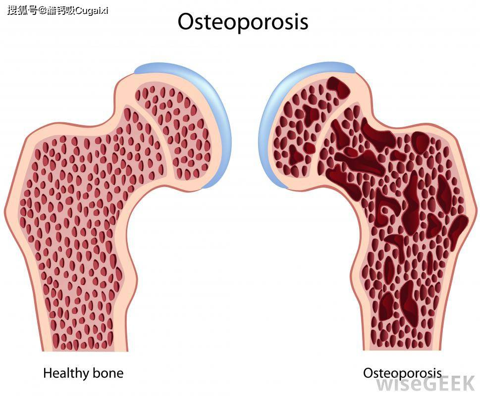 从钙片到骨钙看钙的吸收