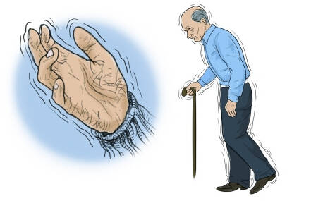 训练|帕金森病患者平衡不好怎么办？