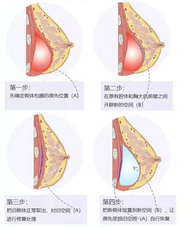 因为科普篇 | 胸部假体取出及修复