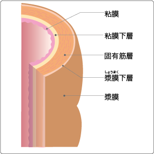 大肠壁分为五层,从内侧分为粘膜(m:mucosa),粘膜下层(sm:submucosa)