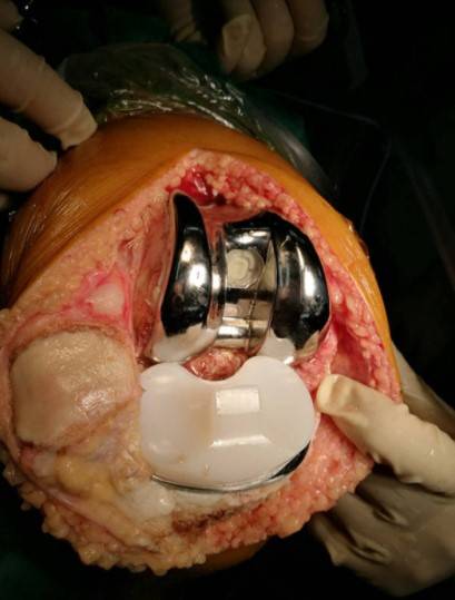 换个假"膝盖"到底好不好?怎样保护能避免换膝盖?让它长久健康_膝关节