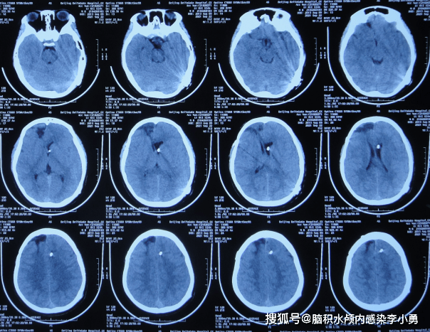 大池|7岁儿童脑出血后脑积水，腰大池引流术后加重感染，顽固性持续发热30余天