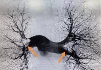 肺动脉|“一根管子” 帮他迈过66岁这道坎儿......