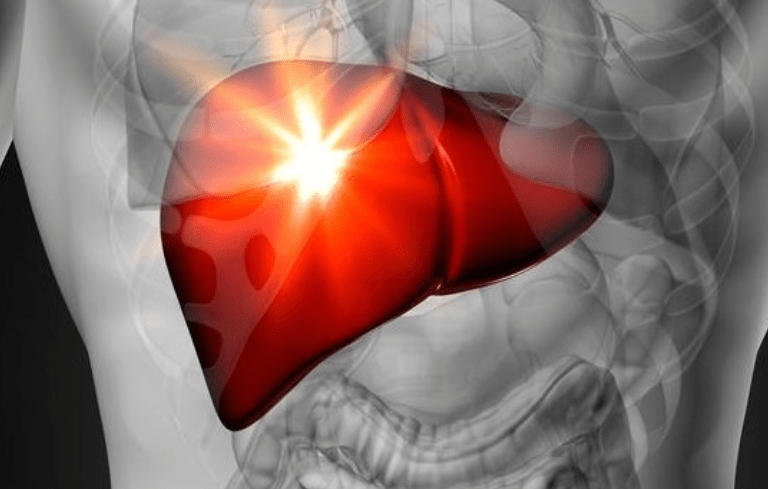 肝脏|豆腐是肝病“发物”？医生提醒：不想肝报废，“4素”赶紧撤下餐桌