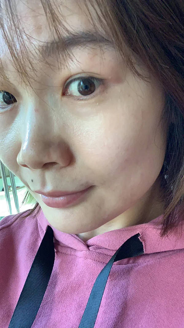 柠檬秦书雅的脸祛痘是真的吗，秦书雅的脸真的如说的那么好吗？