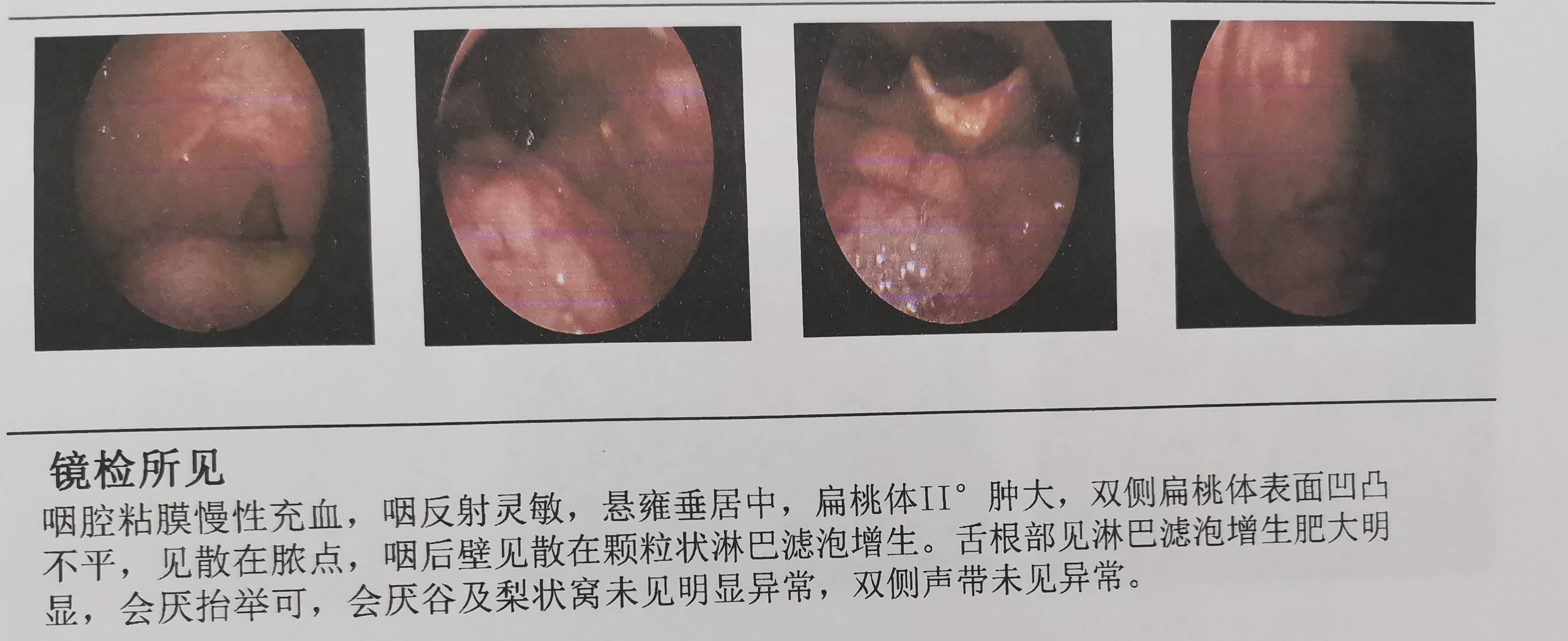 贵阳铭仁耳鼻喉医院:咽痛,咽痒?慢性扁桃体炎可能是"罪魁祸首"