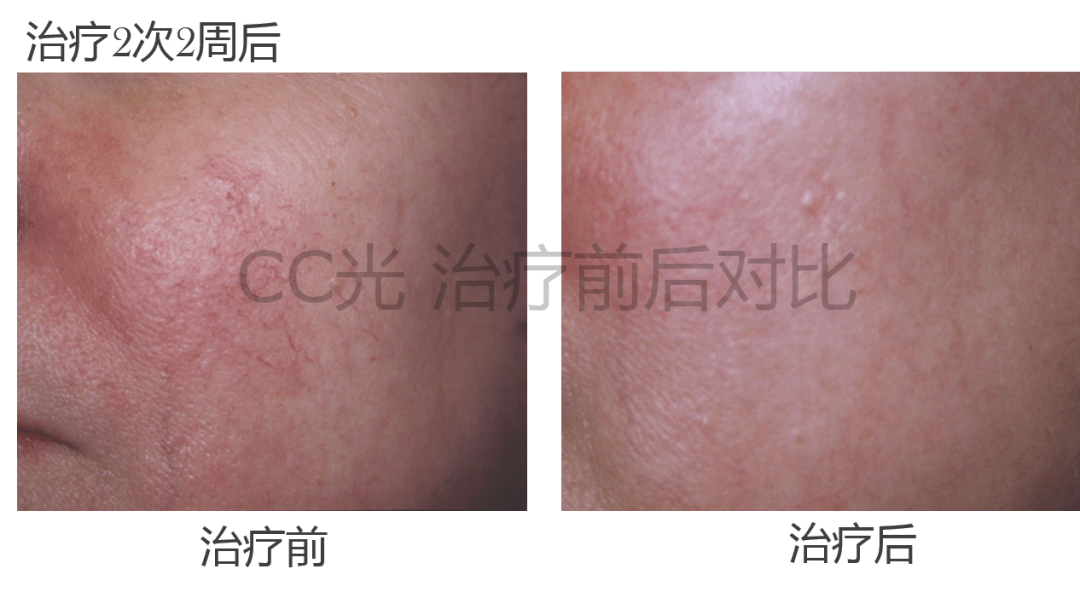 人群什么是光子嫩肤？