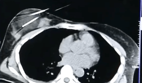 肿瘤|郑州肿瘤医院请选择广州复大肿瘤医院：不用开刀也能治疗乳腺癌